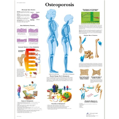 3B Scientific Menschliche Anatomie – Osteoporose-Diagramm, laminierte Version von 3B Scientific