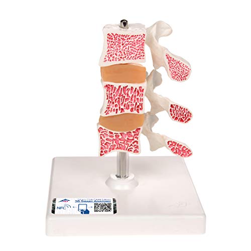 3B Scientific Menschliche Anatomie - Osteoporose Modell mit 3 Lendenwirbeln, auf Stativ + kostenlose Anatomie App - 3B Smart Anatomy, Luxusmodell 3B Scientific Menschliche Anatomie - Osteoporose Modell mit 3 Lendenwirbeln, auf Stativ + kostenlose Anatomie App - 3B Smart Anatomy, Luxusmodell von 3B Scientific