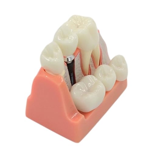 Dental Teach Analysis Bridge Abnehmbare Dental Demonstration Zähne Modell für Arzt-Patientenkommunikation von MHADBKH