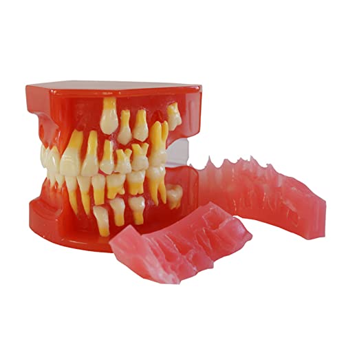 SXRQ Zahnmodell mit 28 abnehmbaren Zähnen, medizinisches Lehrwerkzeug, Zahnwiederherstellung, Demonstrationsmodell für das Studium von SXRQ