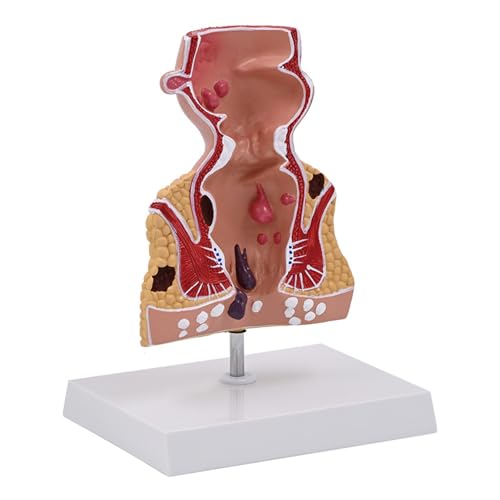 Human Rectum Model for Anatomy Pathologies of Rectum Model Medical Teaching Model Supplies for Study and Display von ZHENNB